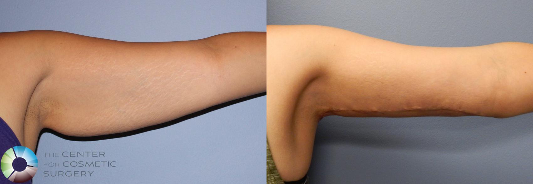 Before & After Arm Lift Case 886 View #4 View in Denver & Golden, CO