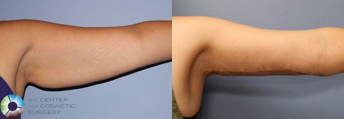Before & After Arm Lift Case 886 View #4 View in Golden, CO