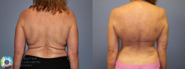Before & After Back Lift (Upper Body Lift) Case 11677 Back View in Golden, CO