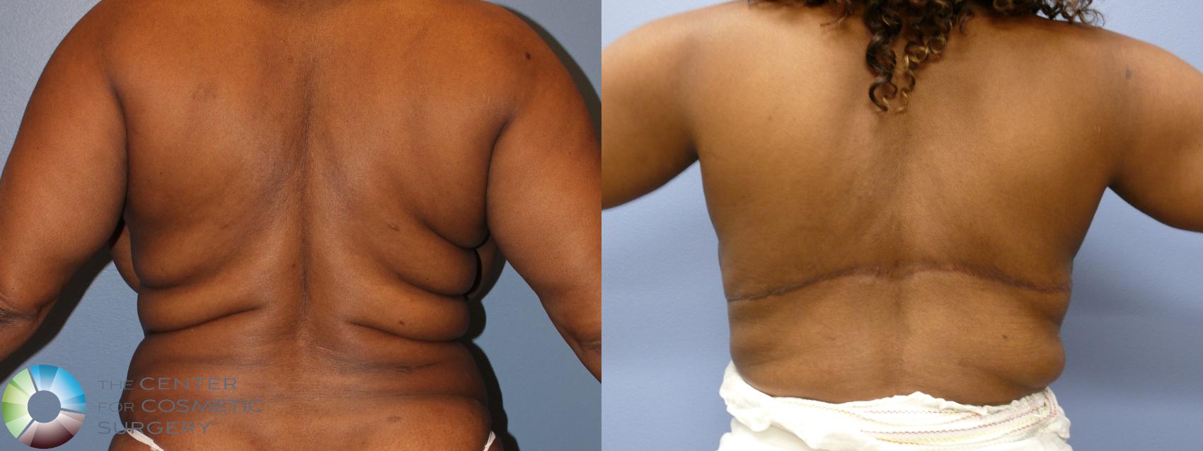 Before & After Back Lift (Upper Body Lift) Case 11684 Back View in Golden, CO