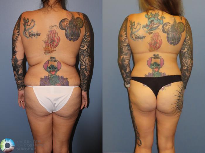 Before & After Back Lift (Upper Body Lift) Case 12066 Back in Denver and Colorado Springs, CO