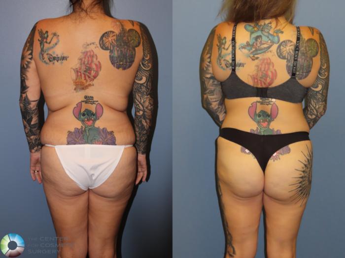 Before & After Back Lift (Upper Body Lift) Case 12066 Back with bra in Denver and Colorado Springs, CO