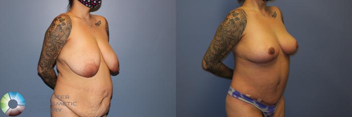 Before & After Back Lift (Upper Body Lift) Case 12066 Right Oblique in Denver and Colorado Springs, CO