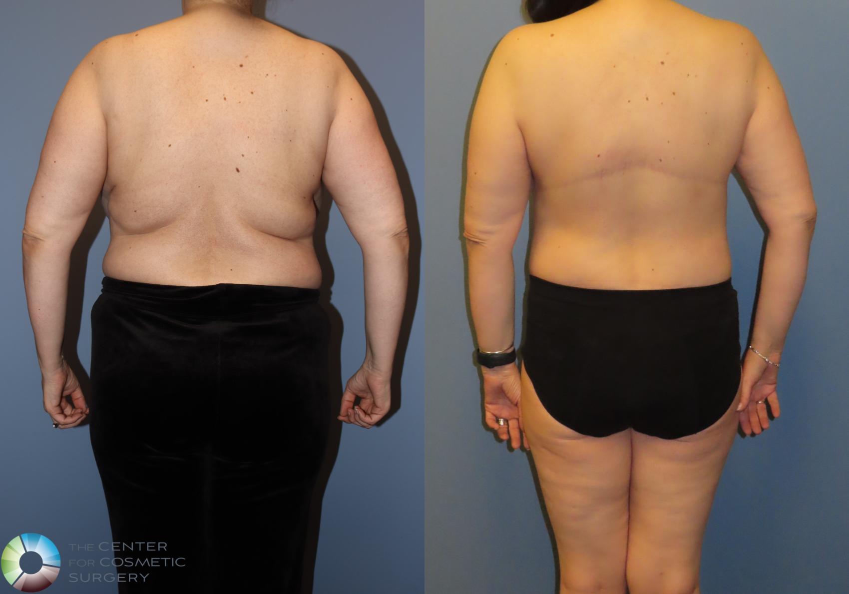 Before & After Back Lift (Upper Body Lift) Case 12068 Back in Denver and Colorado Springs, CO