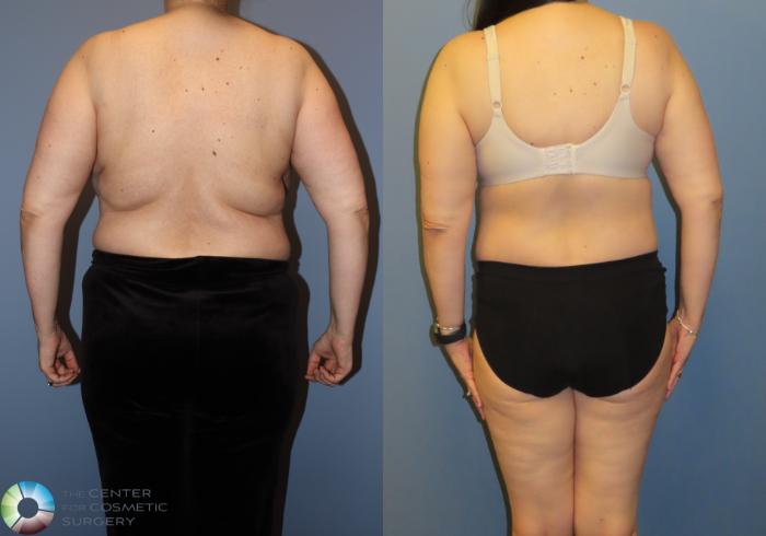 Before & After Back Lift (Upper Body Lift) Case 12068 Back with bra in Denver and Colorado Springs, CO