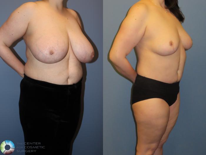 Before & After Back Lift (Upper Body Lift) Case 12068 Right Oblique in Denver and Colorado Springs, CO