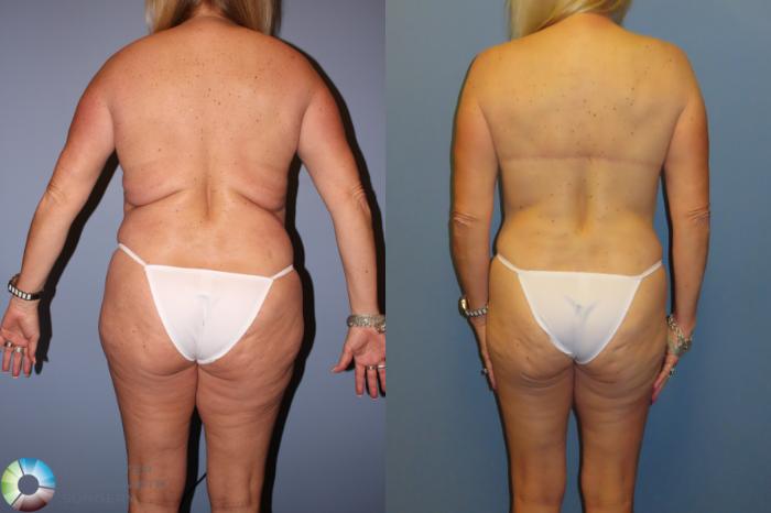 Before & After Back Lift (Upper Body Lift) Case 12071 Back in Denver and Colorado Springs, CO