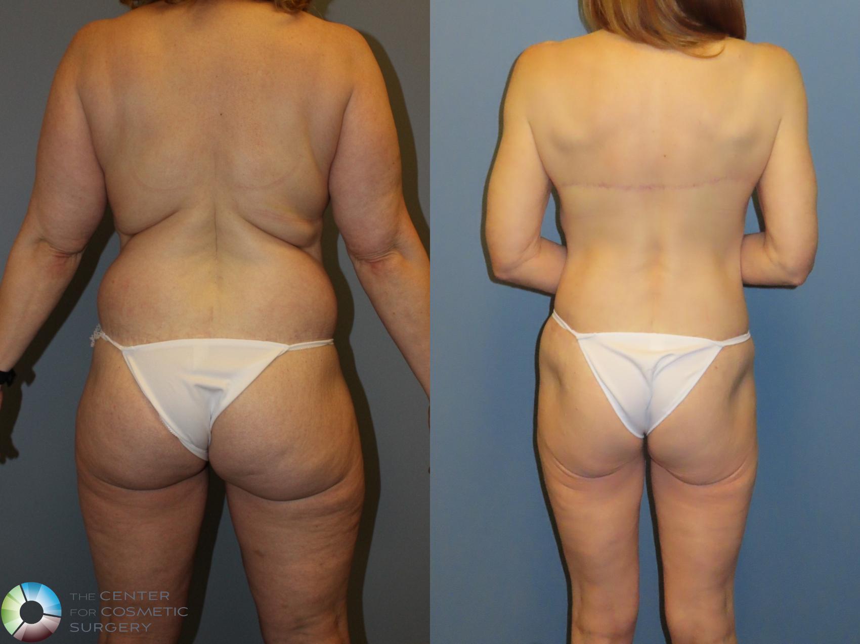 Before & After Back Lift (Upper Body Lift) Case 12072 Back in Denver and Colorado Springs, CO