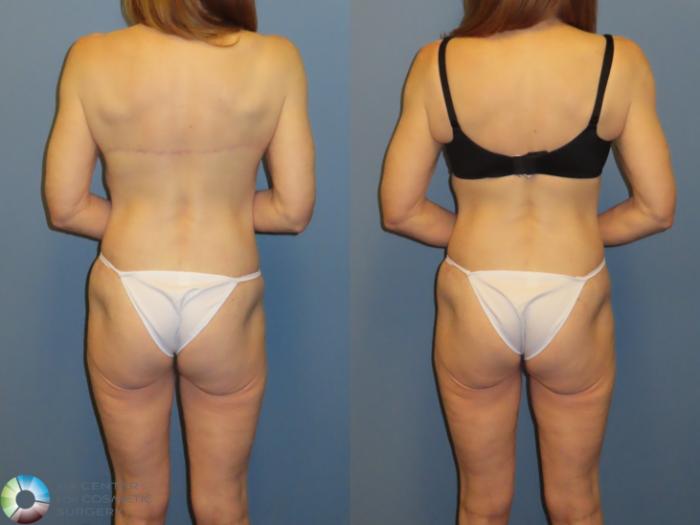 Before & After Back Lift (Upper Body Lift) Case 12072 Back with bra in Denver and Colorado Springs, CO