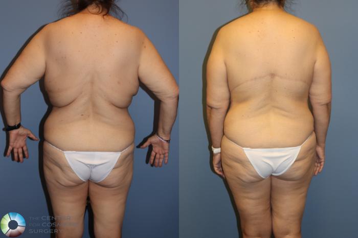 Before & After Back Lift (Upper Body Lift) Case 12073 Back in Denver and Colorado Springs, CO