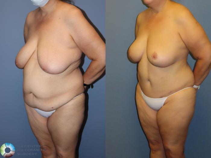 Before & After Back Lift (Upper Body Lift) Case 12073 Left Oblique in Denver and Colorado Springs, CO