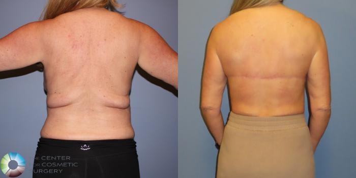 Before & After Back Lift (Upper Body Lift) Case 12074 Back in Denver and Colorado Springs, CO