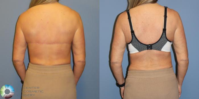 Before & After Back Lift (Upper Body Lift) Case 12074 Back with bra in Denver and Colorado Springs, CO