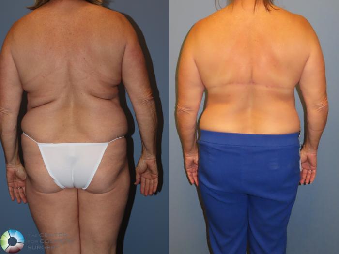 Before & After Back Lift (Upper Body Lift) Case 12075 Back in Denver and Colorado Springs, CO