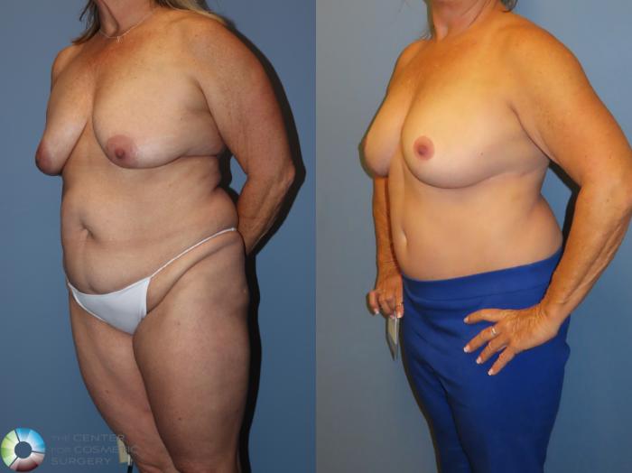 Before & After Back Lift (Upper Body Lift) Case 12075 Left Oblique in Denver and Colorado Springs, CO