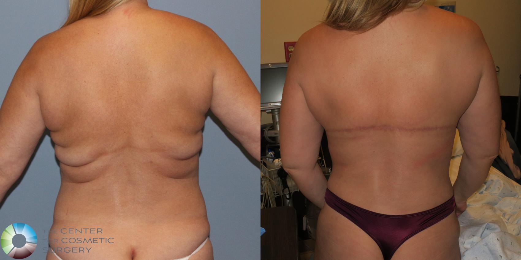 Before & After Back Lift (Upper Body Lift) Case 12076 Back in Denver and Colorado Springs, CO