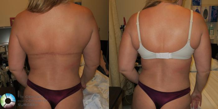 Before & After Back Lift (Upper Body Lift) Case 12076 Back with bra in Denver and Colorado Springs, CO