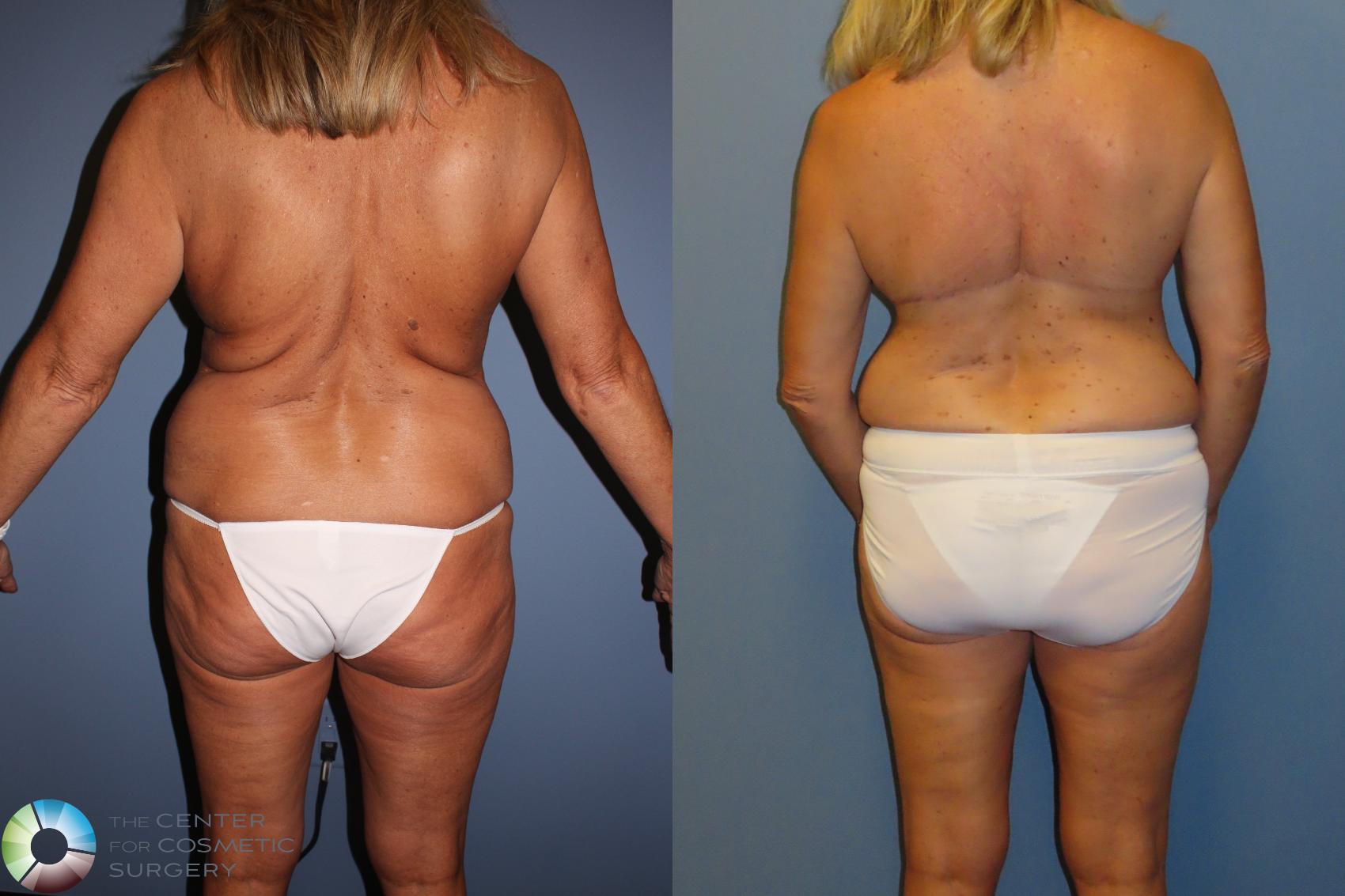 Before & After Back Lift (Upper Body Lift) Case 12097 Back in Denver and Colorado Springs, CO