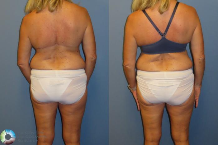 Before & After Back Lift (Upper Body Lift) Case 12097 Back with bra in Denver and Colorado Springs, CO