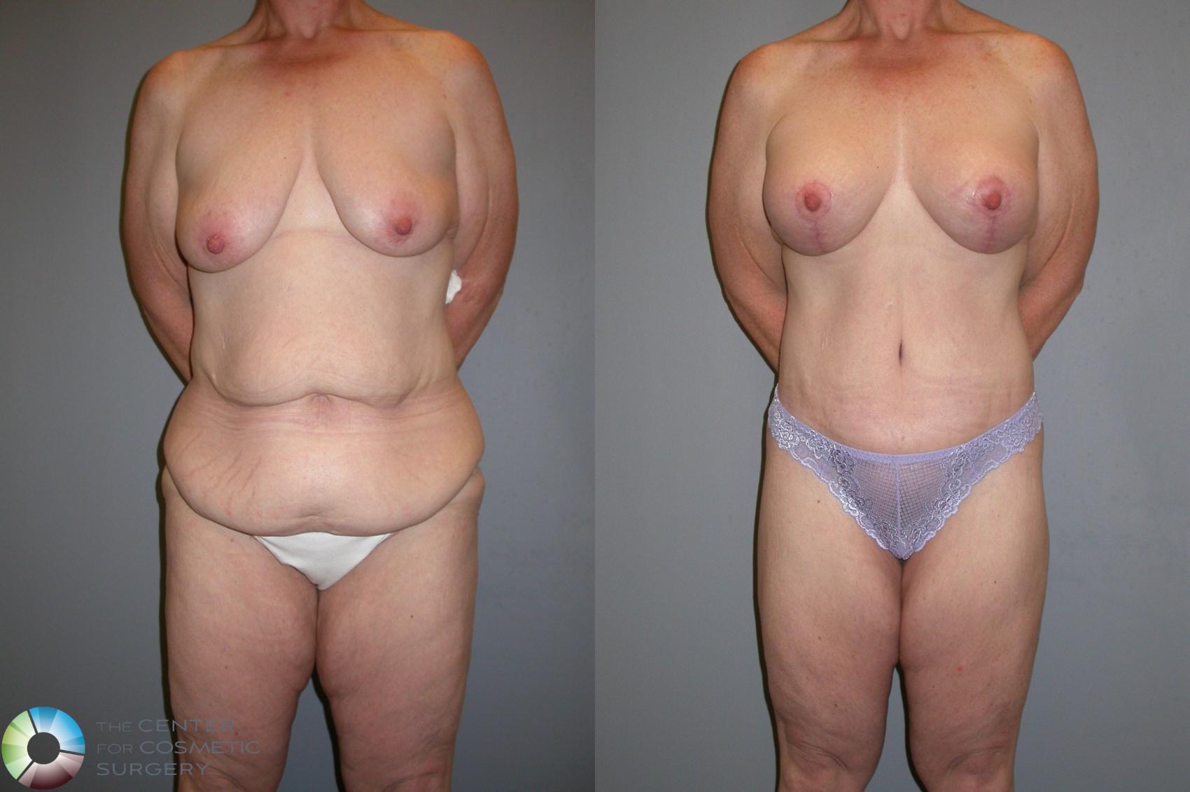 Before & After Buttock Lift Case 105 View #1 in Denver and Colorado Springs, CO