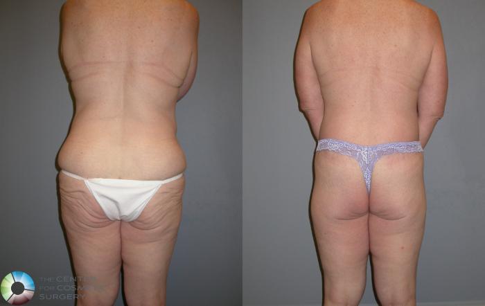 Before & After Body Lift Case 105 View #2 View in Golden, CO