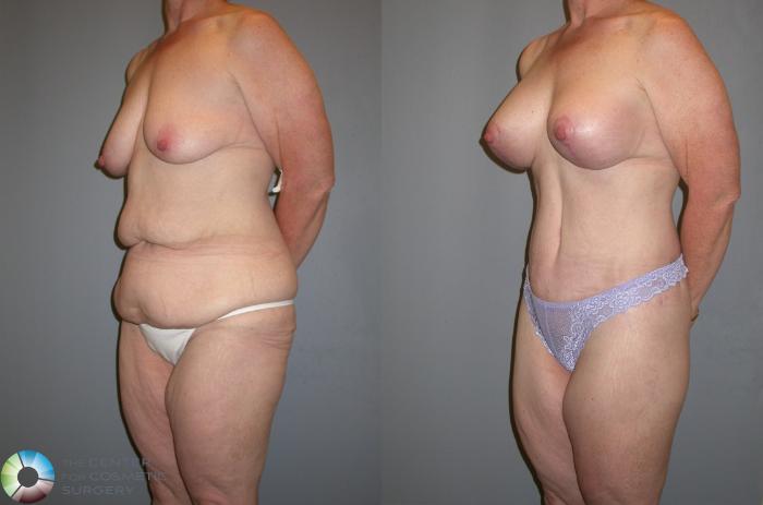 Before & After Thigh Lift Case 105 View #4 View in Golden, CO