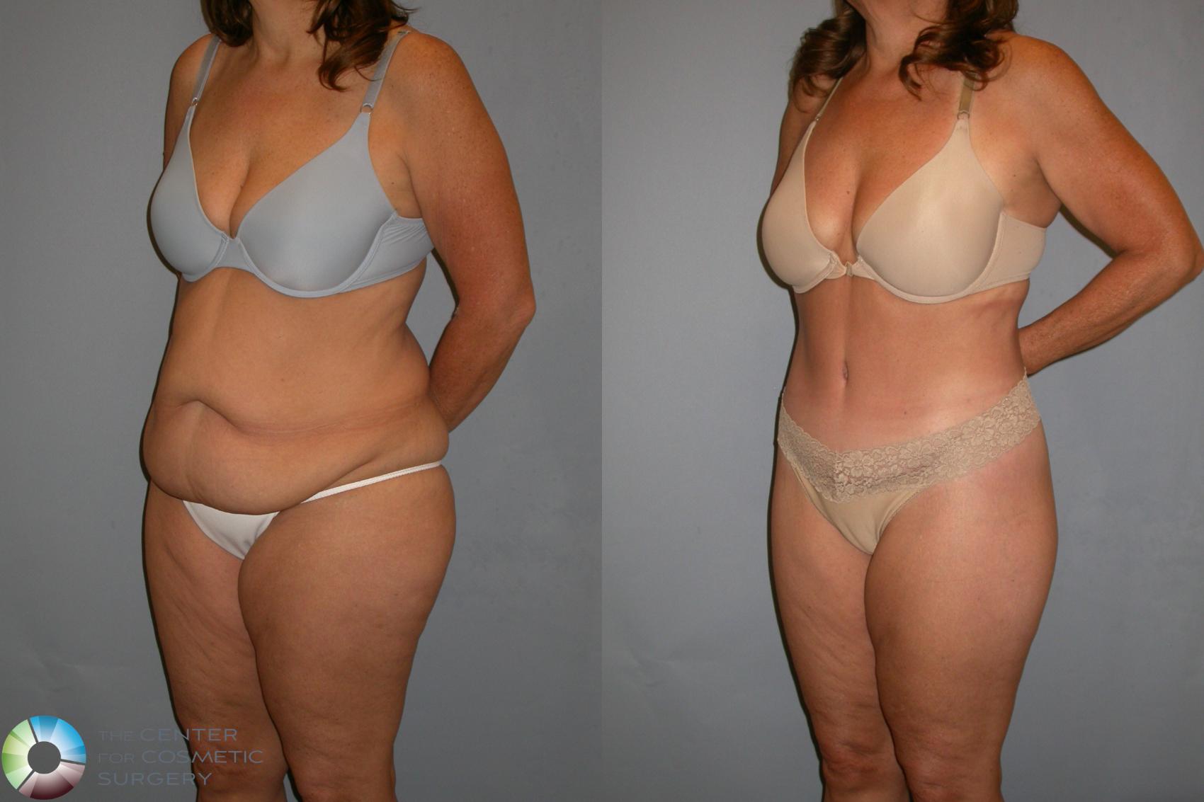 Before & After Thigh Lift Case 110 View #1 in Denver and Colorado Springs, CO