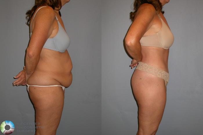 Before & After Thigh Lift Case 110 View #2 View in Golden, CO