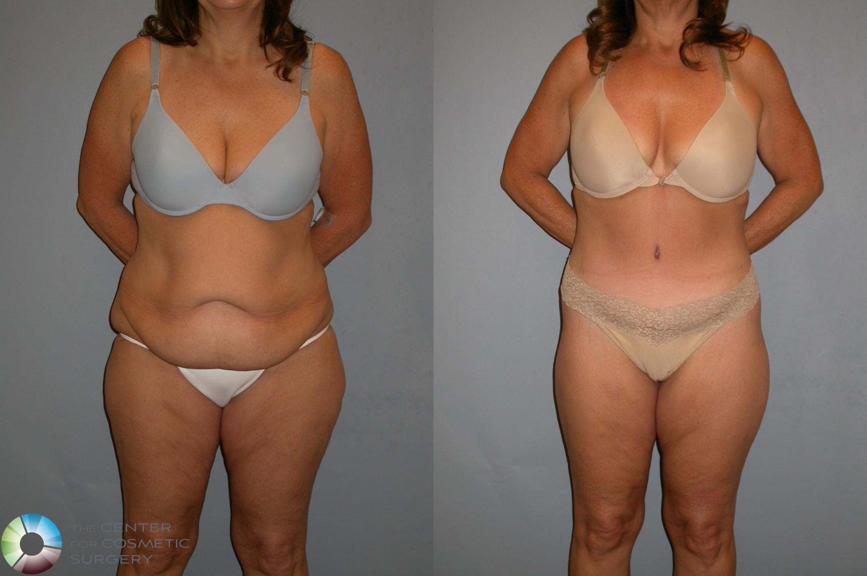 Before & After Body Lift Case 110 View #3 View in Golden, CO