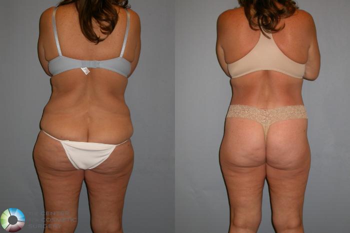 Before & After Thigh Lift Case 110 View #4 View in Golden, CO