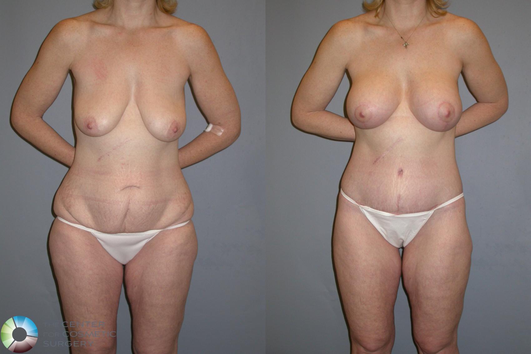 Before & After Thigh Lift Case 111 View #1 in Denver, CO