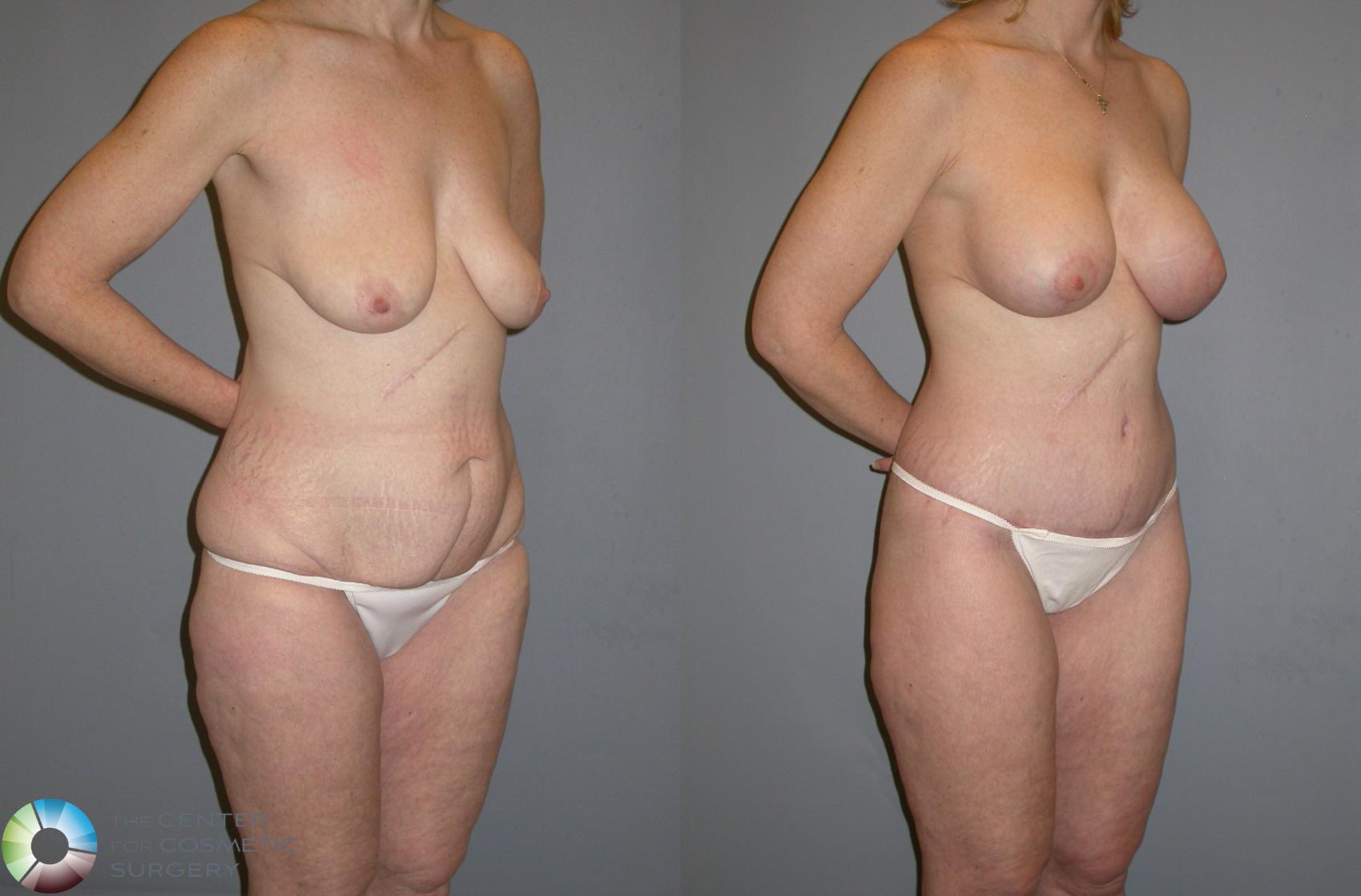 Before & After Body Lift Case 111 View #2 in Denver and Colorado Springs, CO