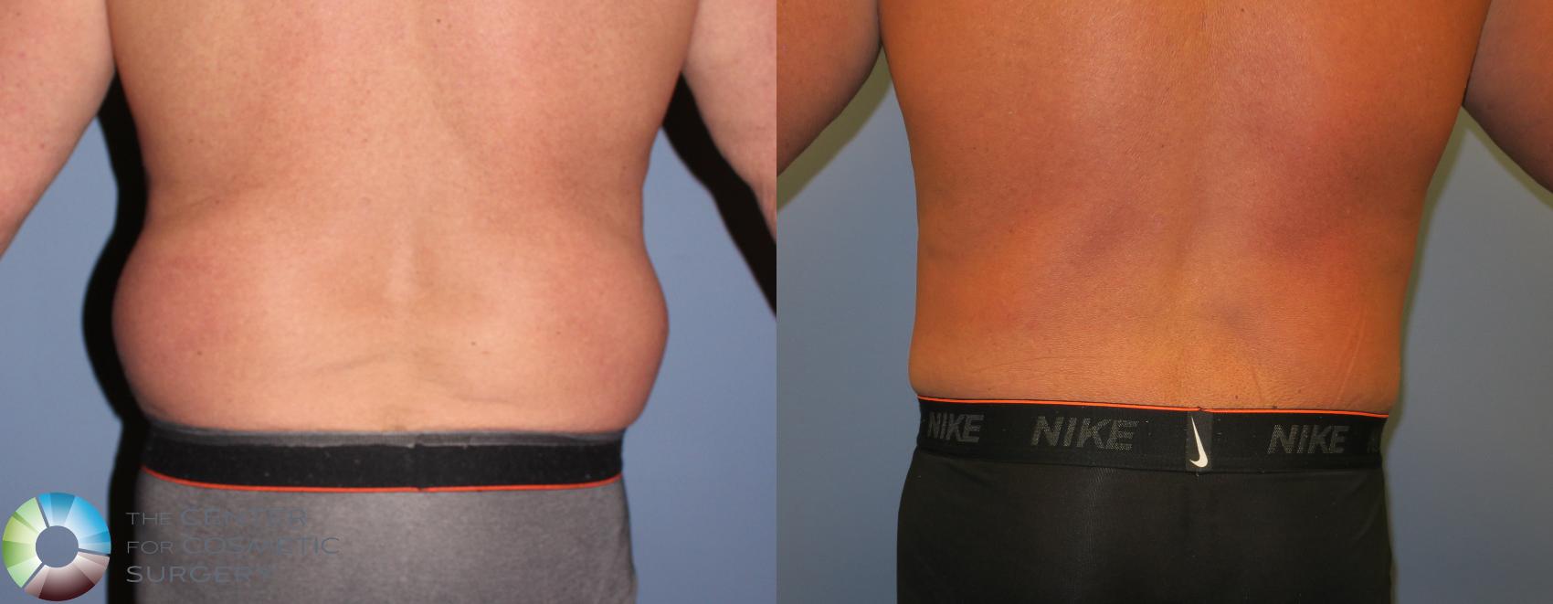 Before & After Buttock Lift Case 11199 Back View in Denver & Golden, CO