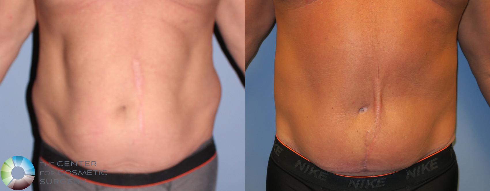 Before & After Body Lift Case 11199 Front in Denver and Colorado Springs, CO