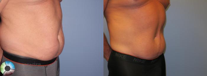 Before & After Body Lift Case 11199 Right Oblique View in Golden, CO