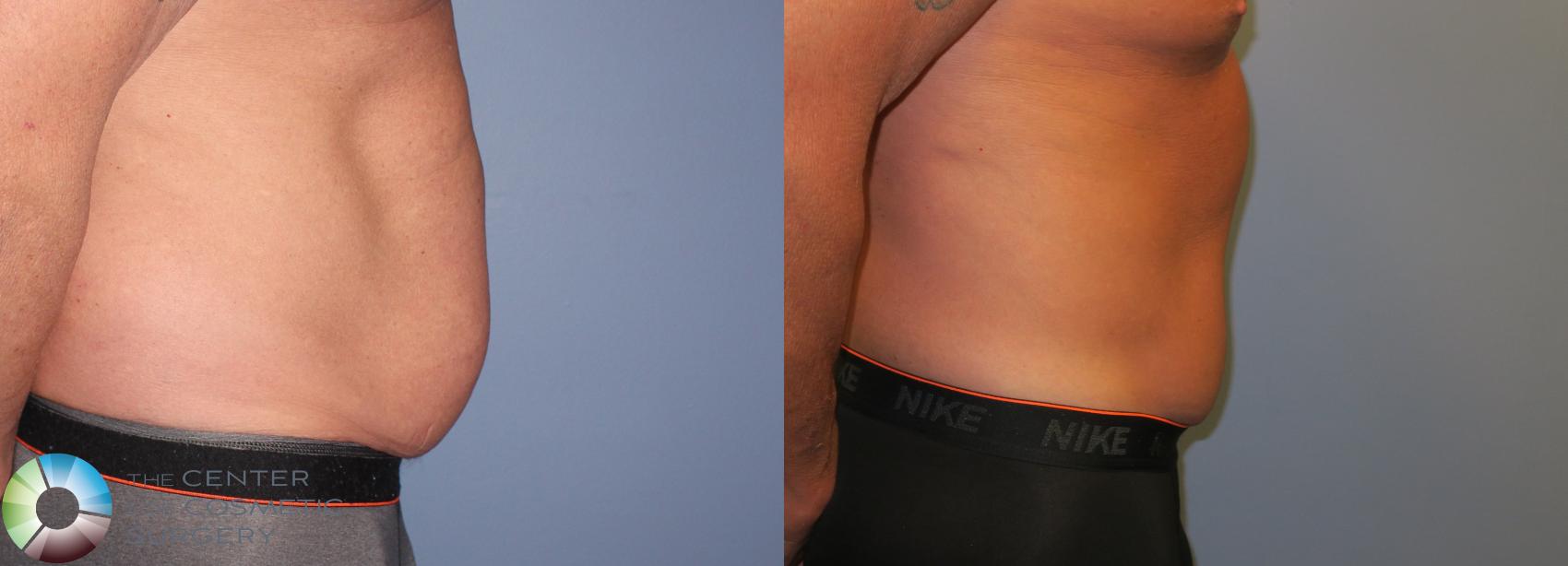 Before & After Body Lift Case 11199 Right Side in Denver and Colorado Springs, CO