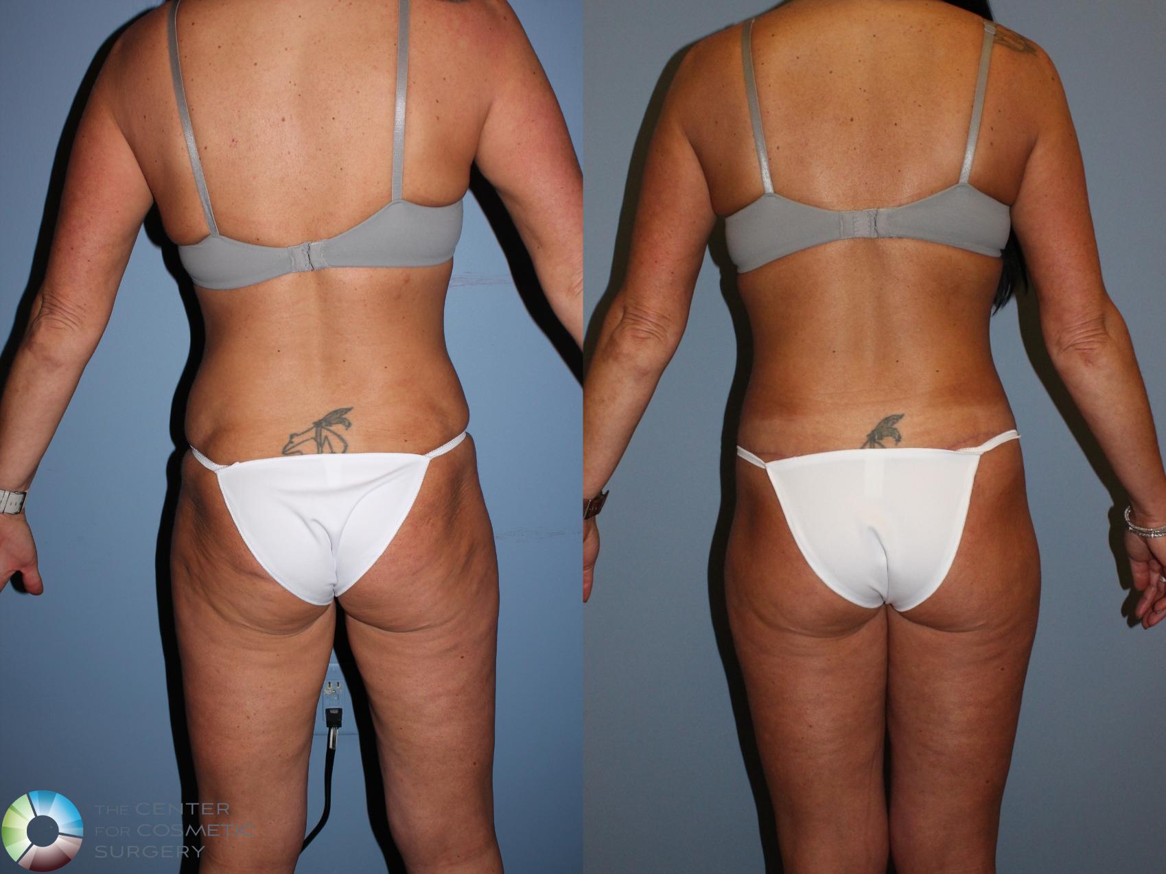 Before & After Body Lift Case 11523 Back View in Golden, CO
