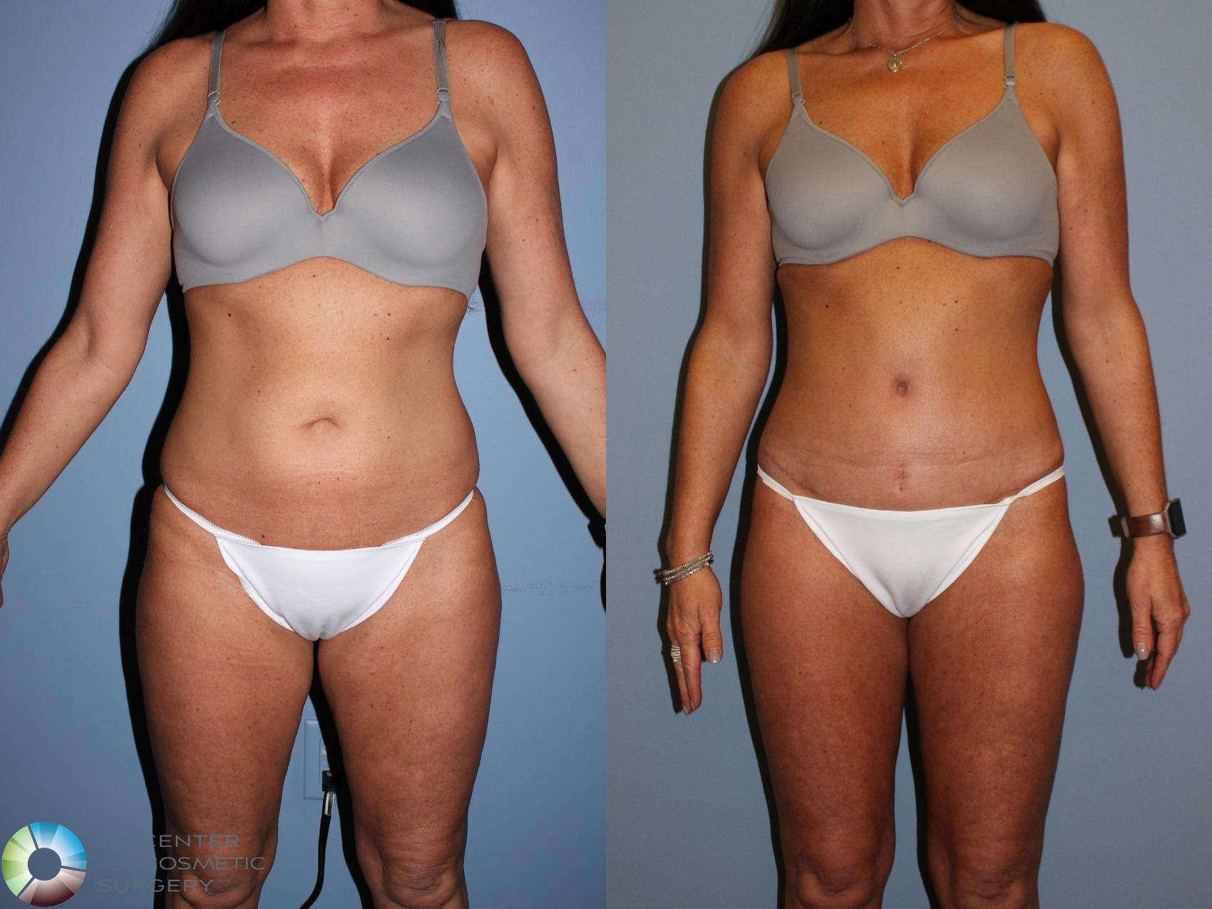 Before & After Body Lift Case 11523 Front View in Denver & Golden, CO