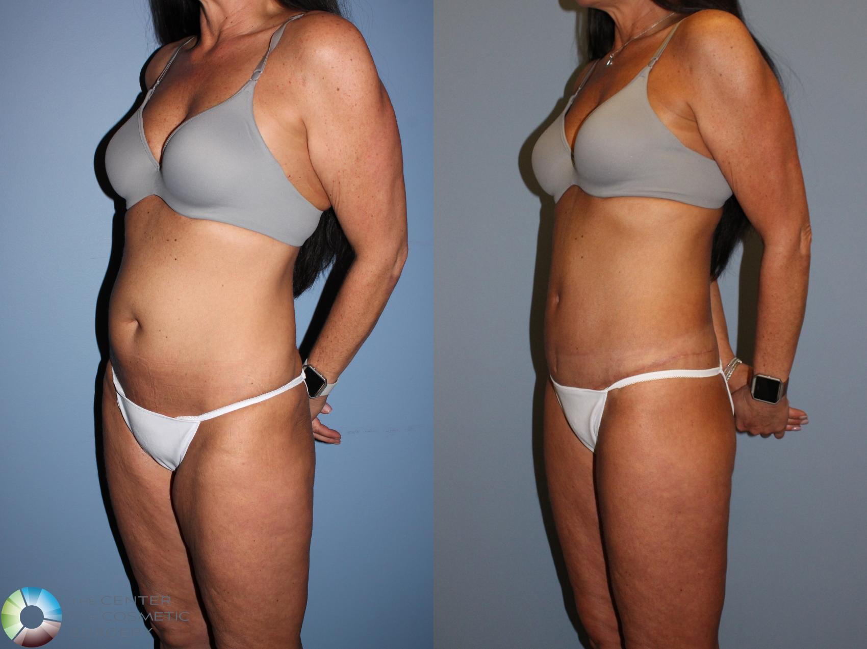 Before & After Body Lift Case 11523 Left Oblique View in Golden, CO