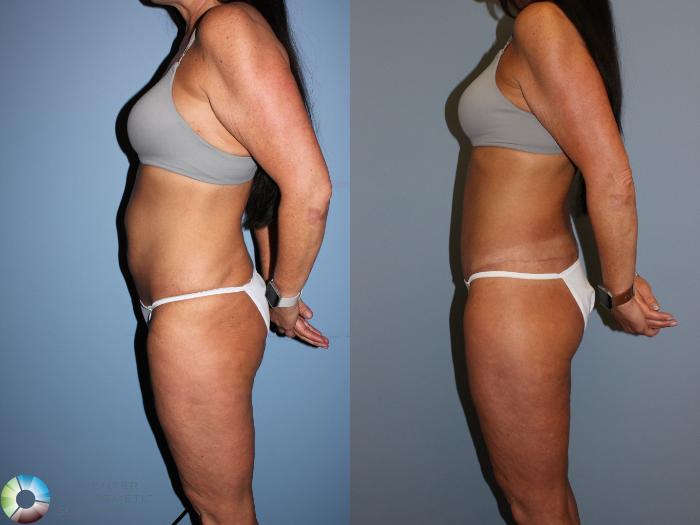 Before & After Body Lift Case 11523 Left Side View in Golden, CO