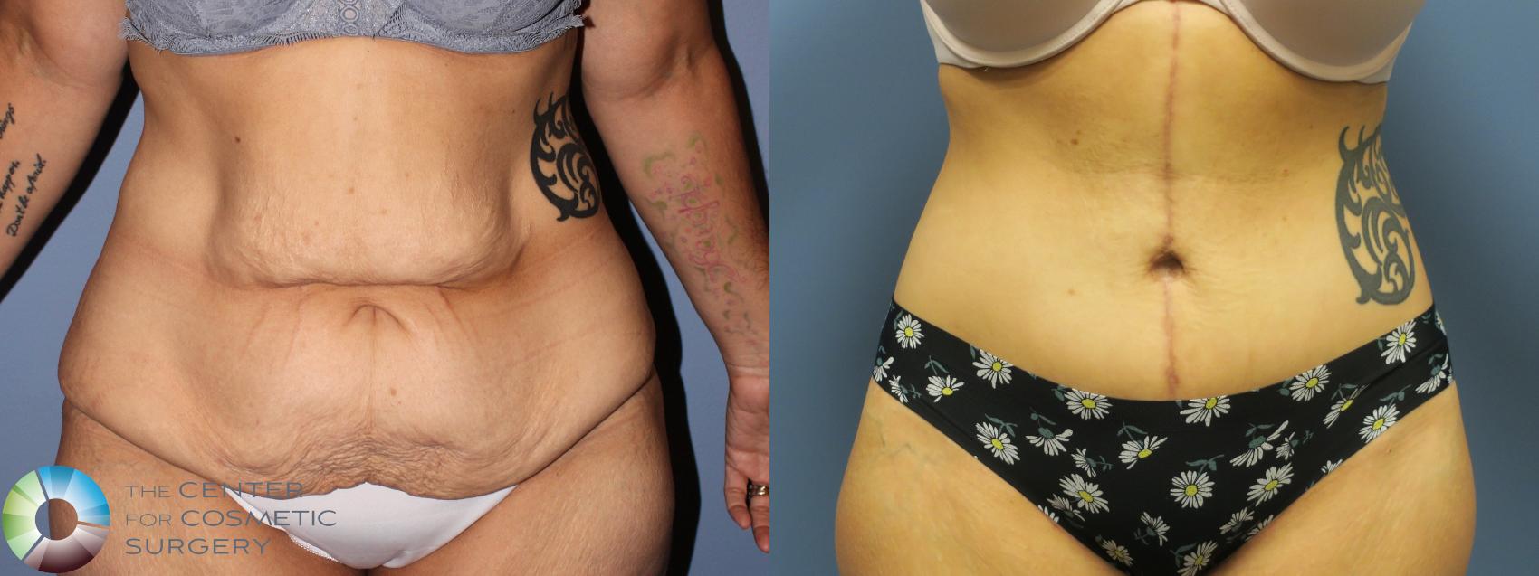Before & After Body Lift Case 11927 Front in Denver and Colorado Springs, CO