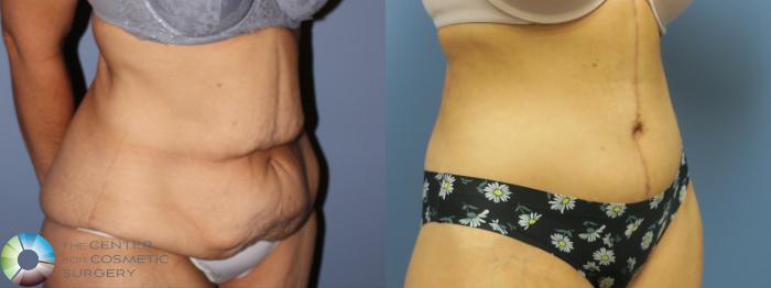 Before & After Body Lift Case 11927 Right Oblique in Denver and Colorado Springs, CO