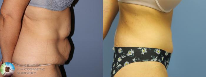 Before & After Body Lift Case 11927 Right Side in Denver and Colorado Springs, CO