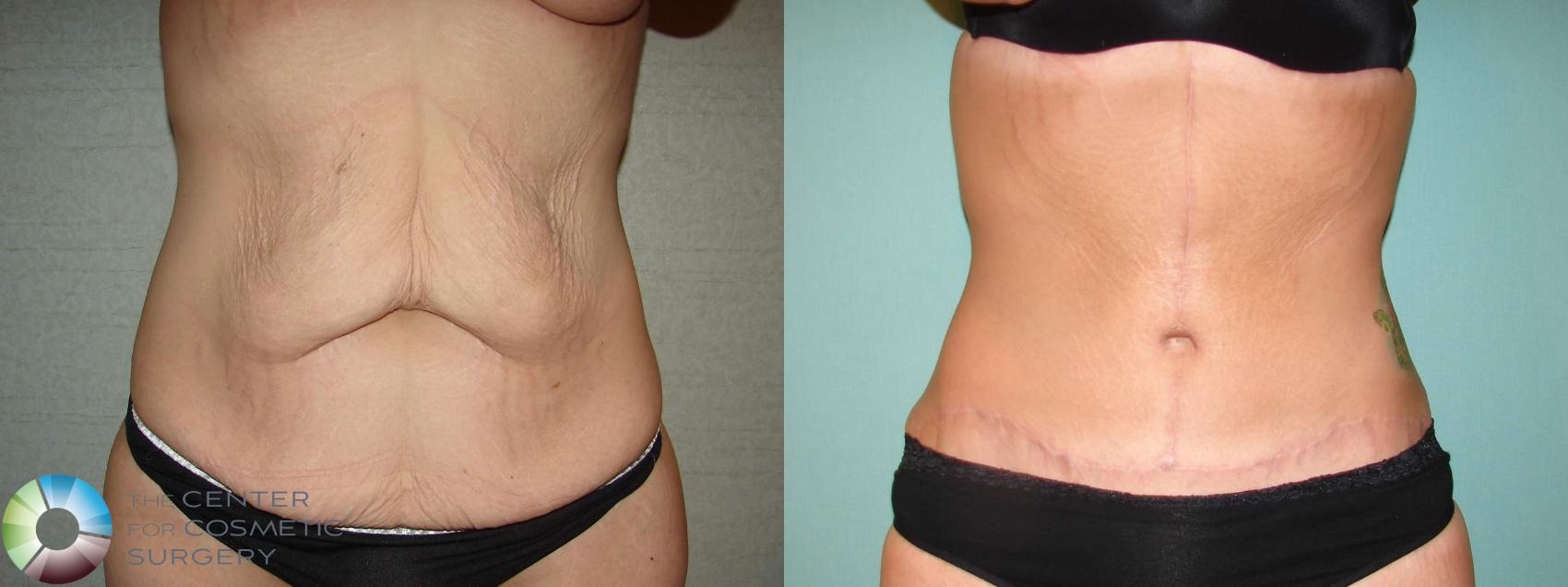 Before & After Tummy Tuck Case 11939 Front in Denver and Colorado Springs, CO