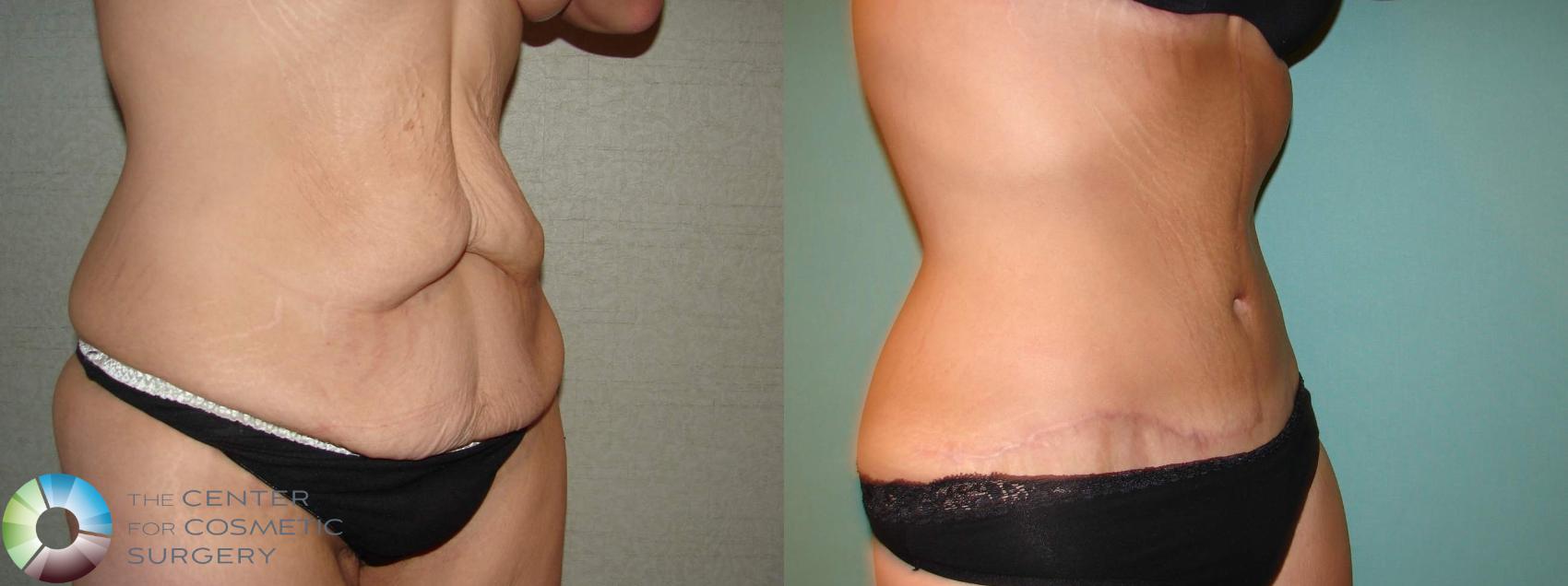 Before & After Body Lift Case 11939 Right Oblique in Denver and Colorado Springs, CO