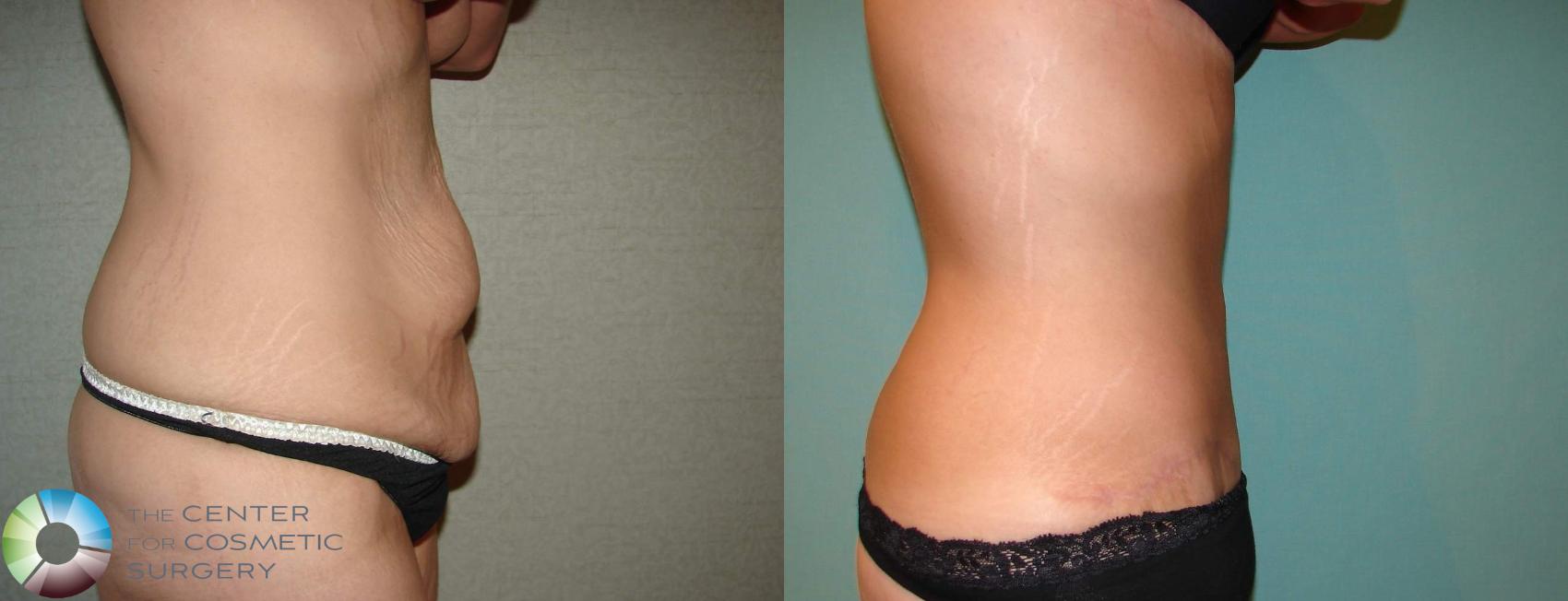 Before & After Body Lift Case 11939 Right Side in Denver and Colorado Springs, CO
