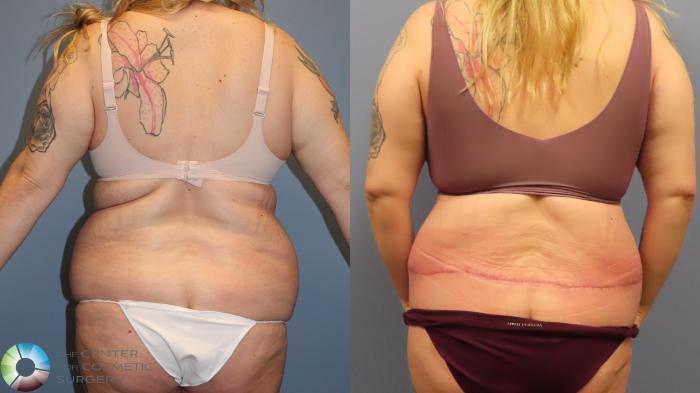 Before & After Buttock Lift Case 11948 Back in Denver and Colorado Springs, CO