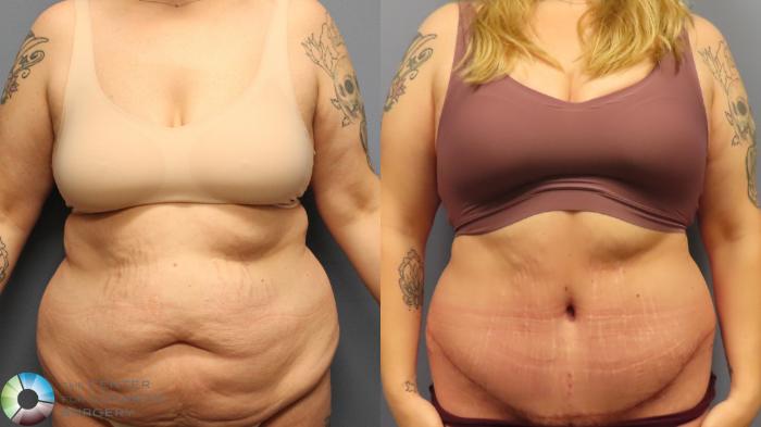 Before & After Tummy Tuck Case 11948 Front in Denver and Colorado Springs, CO
