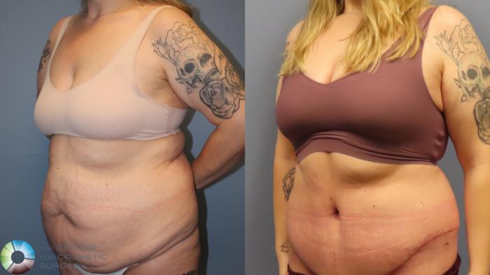 Before & After Tummy Tuck Case 11948 Left Oblique in Denver and Colorado Springs, CO