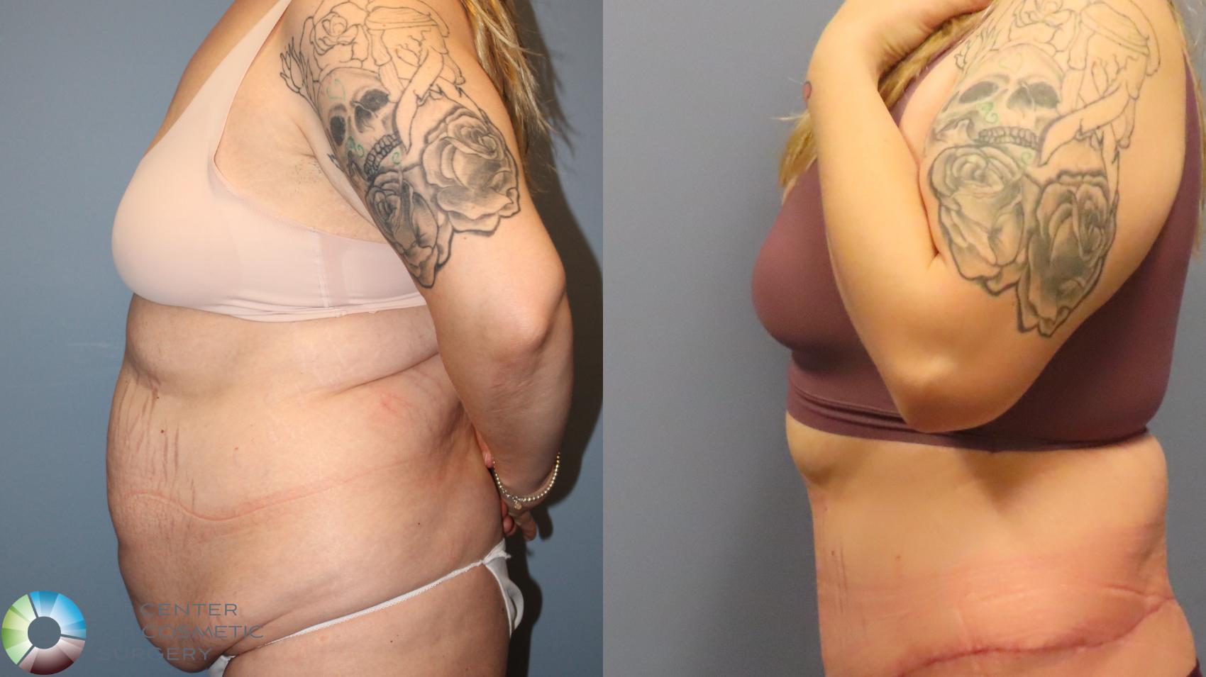 Before & After Tummy Tuck Case 11948 Left Side in Denver and Colorado Springs, CO